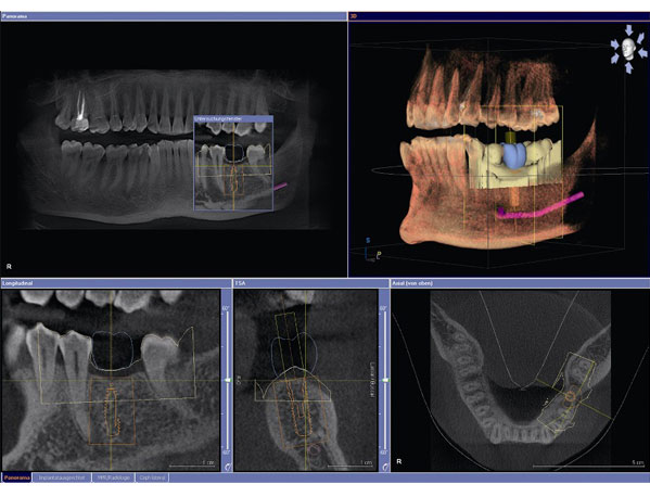 CBCT Cone Beam Technology Scan Dental Procedure