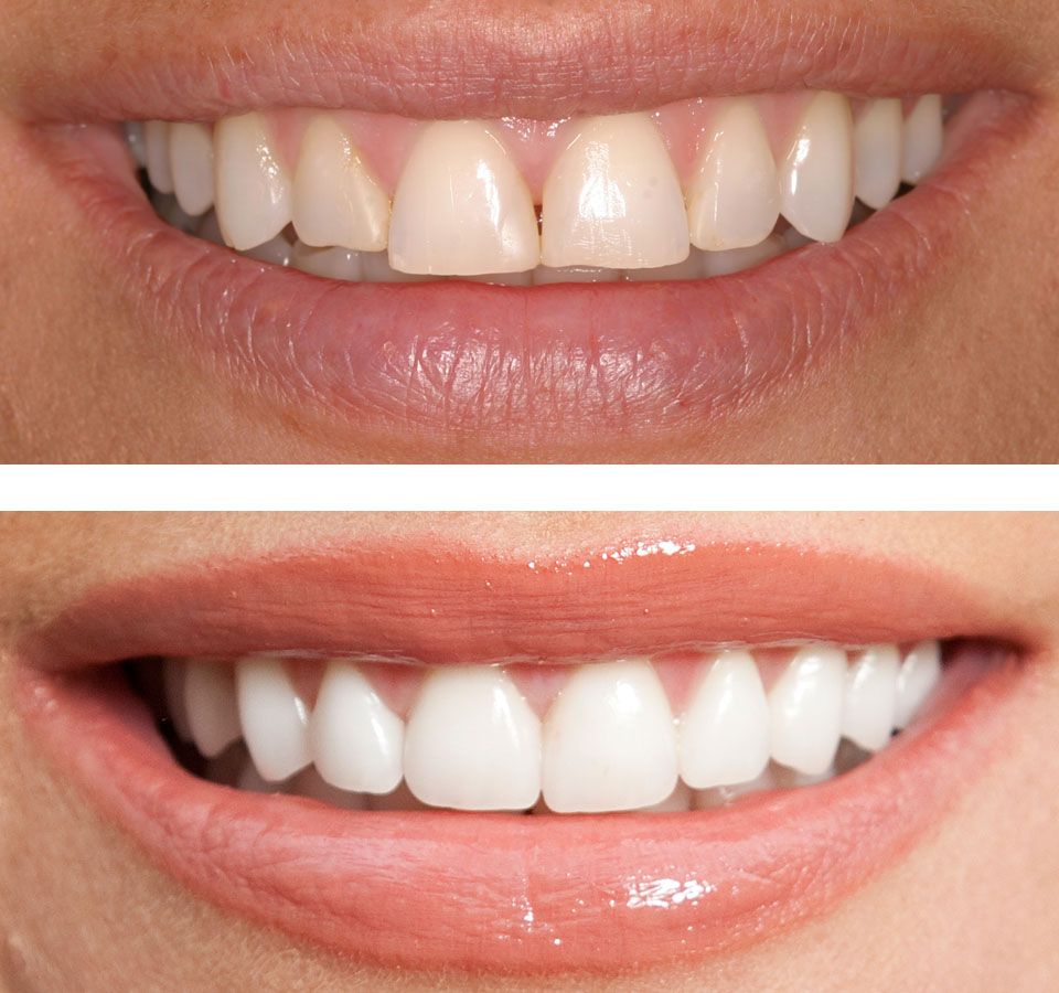 Dental-Bonding-before-after-Parker-Dental