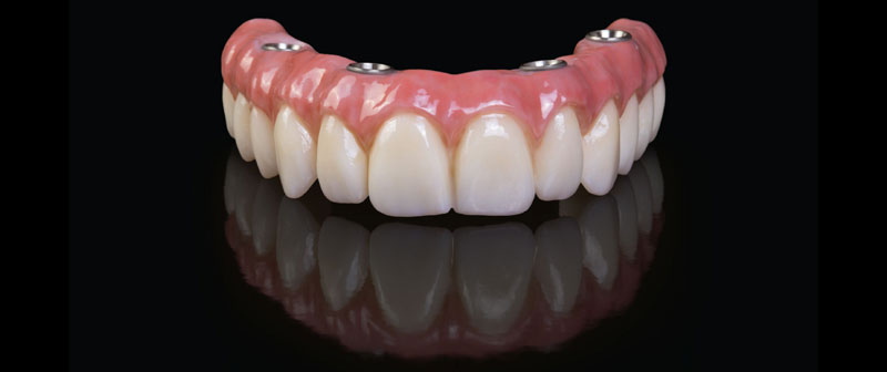 Parker-Dental-Group-Implant-Dentures